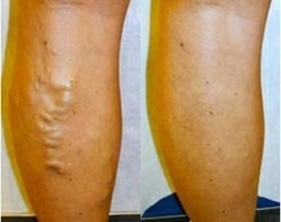 Ce complicații patologice pot provoca varicele picioarelor?