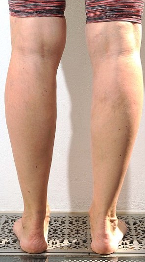 Julia Bradbury's legs after varicose veins treatment