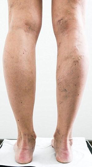 Julia Bradbury's legs before varicose veins treatment