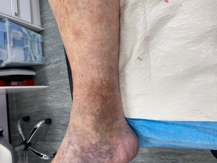 Venous leg ulcer after treatment