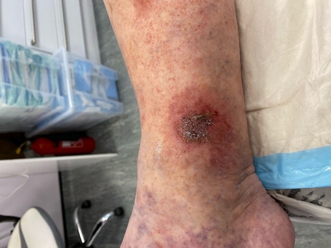 Venous leg ulcer before treatment