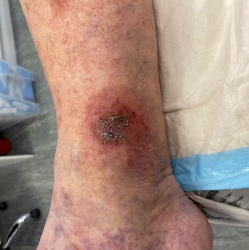 Leg ulcer