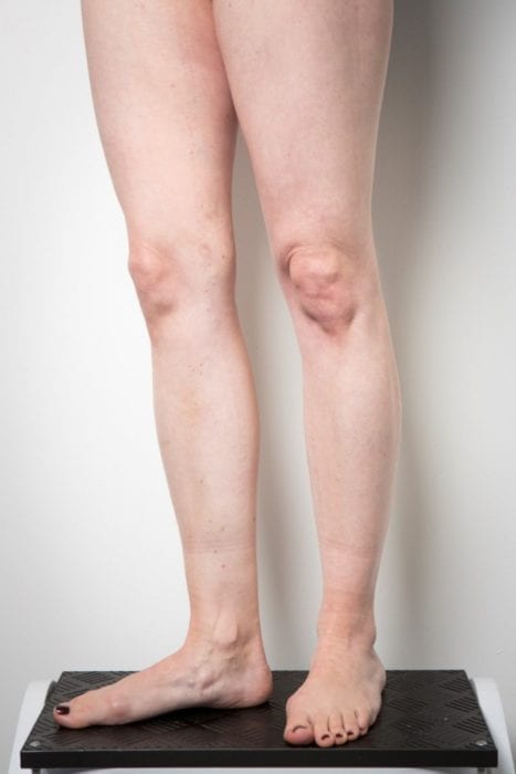 Legs after varicose veins treatment