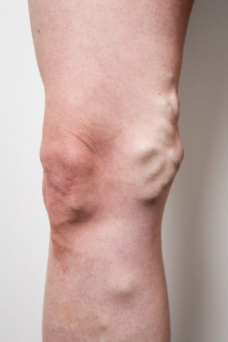 Leg before varicose veins treatment