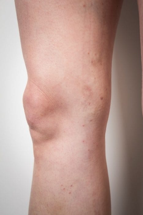 Leg after varicose veins treatment