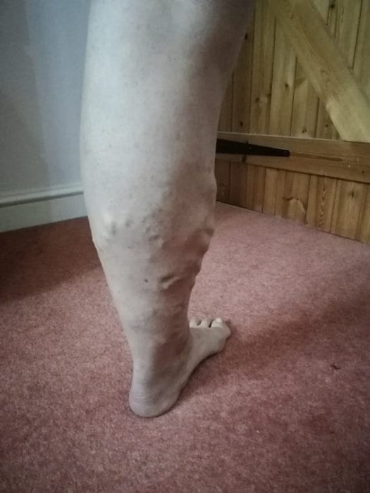 Ruth's legs before varicose veins treatment