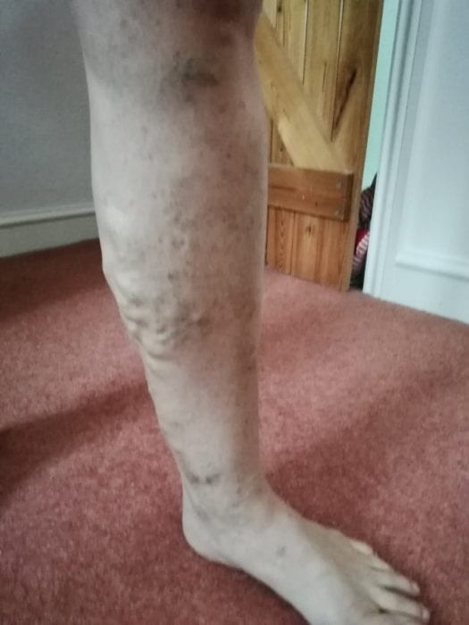 Ruth's legs before varicose veins treatment