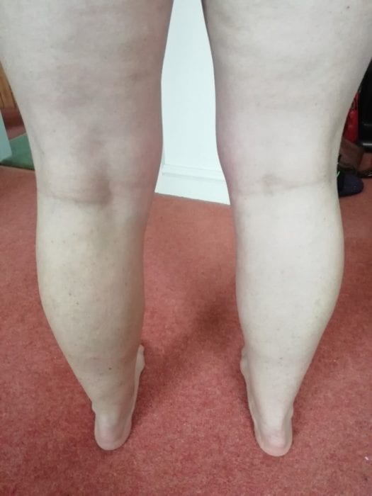 Ruth's legs after varicose veins treatment