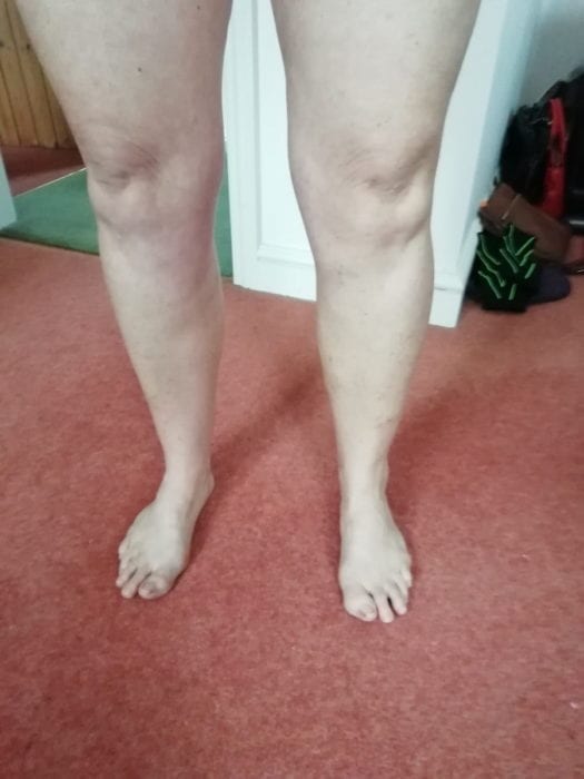 Ruth's legs after varicose veins treatment