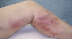 Bruised Varicose Veins: What Are The Risks? - UVVC
