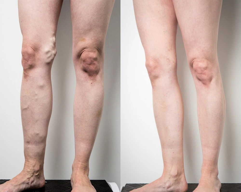 Before & After Photos: Varicose Vein Treatment