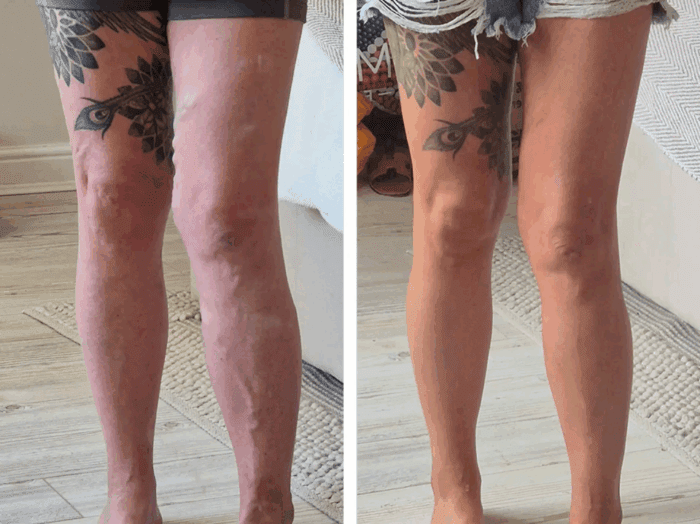 VeinCentre's patient Sue before & afters