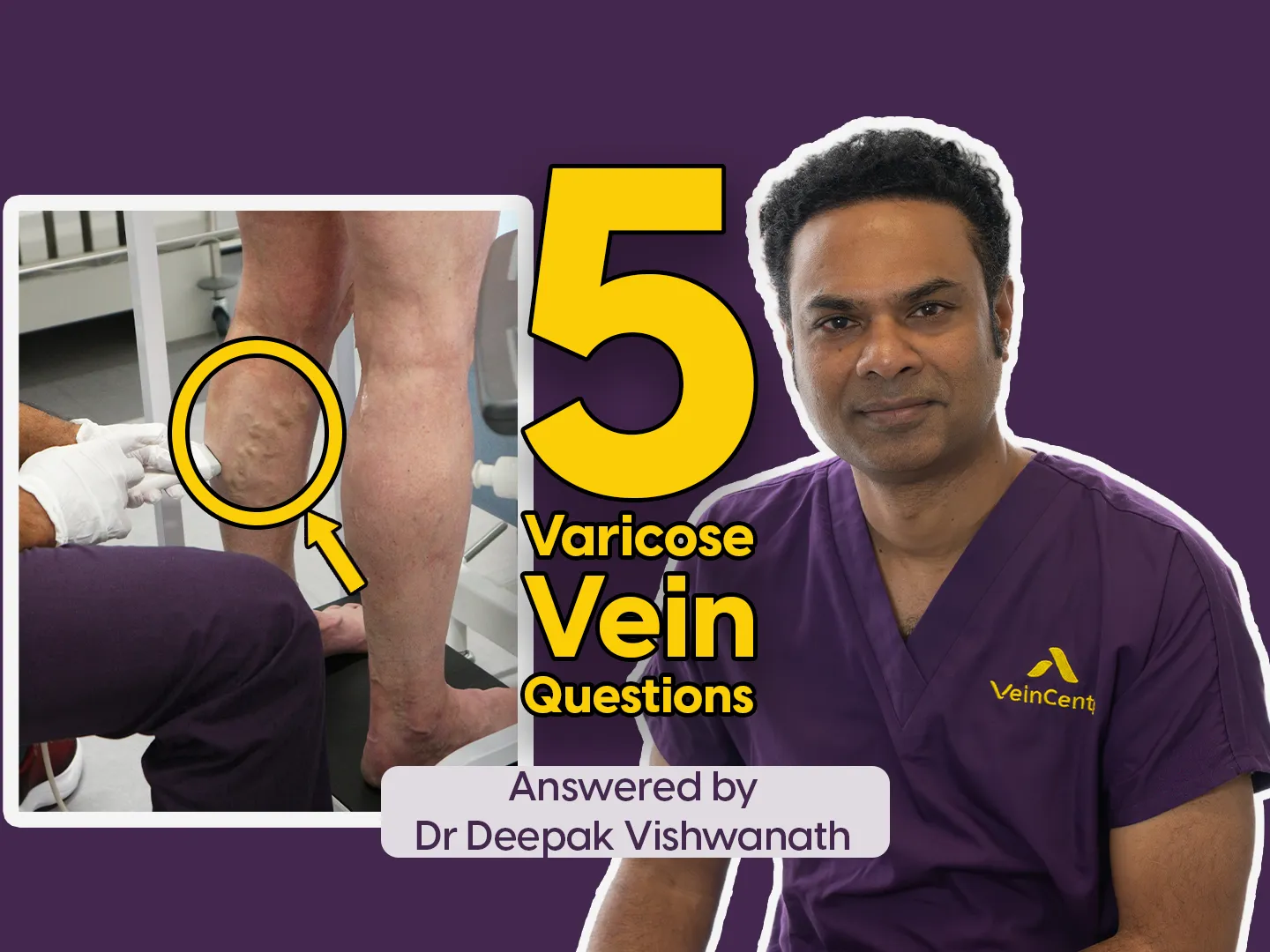 Your Top 5 Varicose Vein Questions