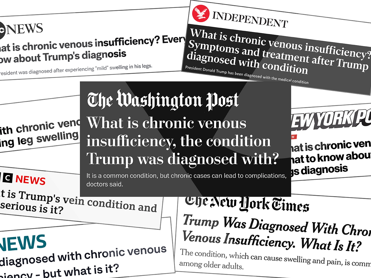 Donald Trump’s Vein Condition: Chronic Venous Insufficiency