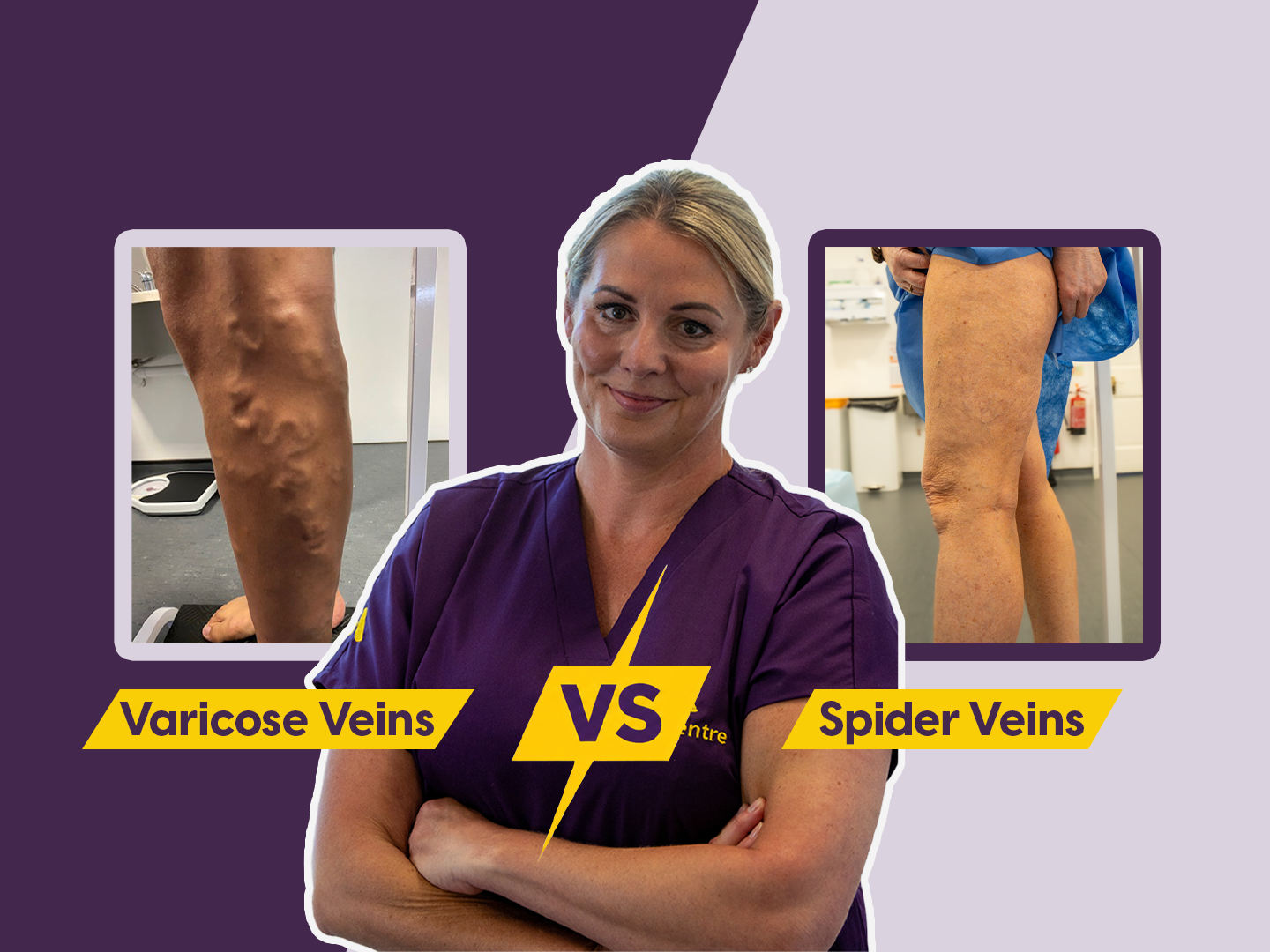 Spider Veins or Varicose Veins? How to Tell the Difference